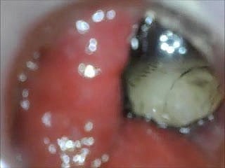 การเล่นตูด endoscope ทางทวารหนักจากภายใน